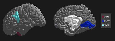 Migraine with aura detection and subtype classification using machine learning algorithms and morphometric magnetic resonance imaging data